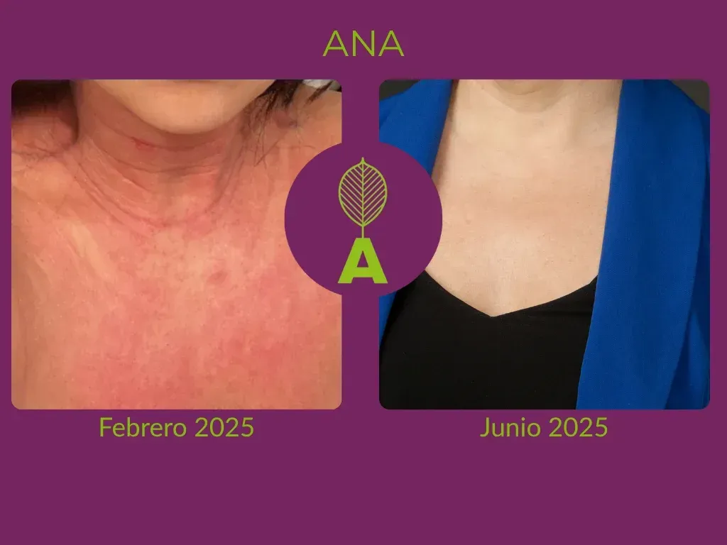 5 lecciones del caso Ana: de eccema crónico a piel estable en 90 días