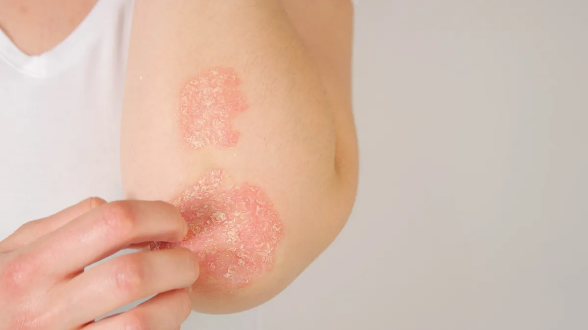 psoriasis y sistema inmune