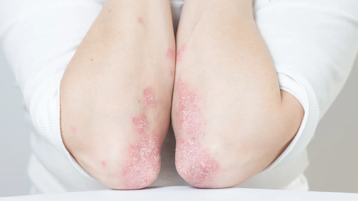 psoriasis