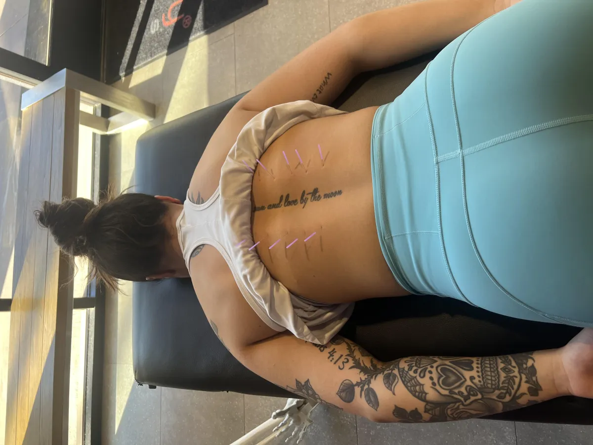 Dry Needling