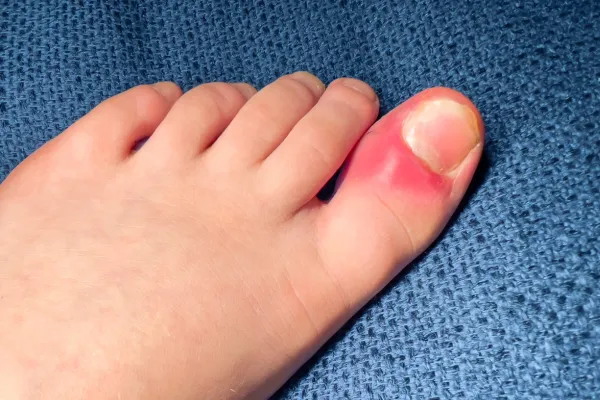 When Your Big Toe Is the Problem: Painful Hallux Limitus Explained