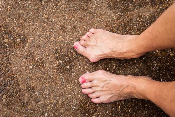 Why Do My Toes Curl? Understanding Hammertoes and Claw Toes