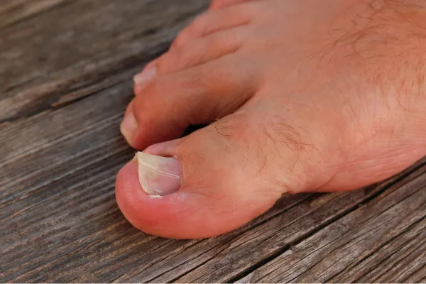 Why Your Ingrown Toenail Isn’t Healing – And How We Can Fix It