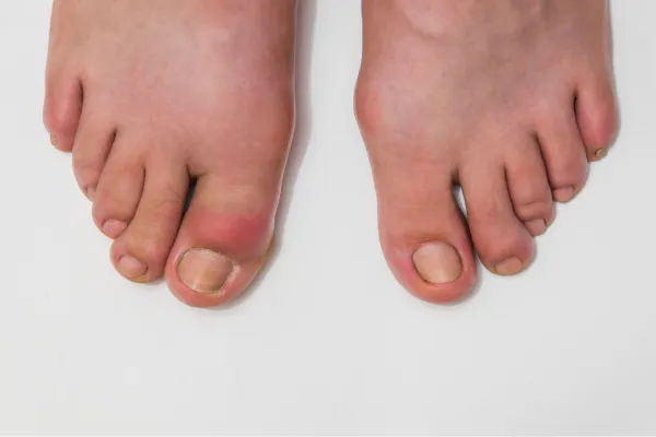 Struggling to Bend Your Big Toe? It Could Be Hallux Rigidus