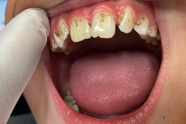 Black stains on children's teeth
