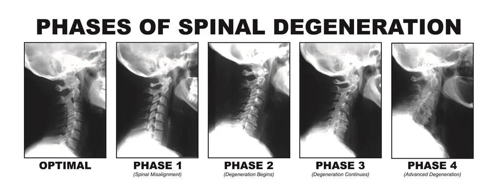 spinal degeneration