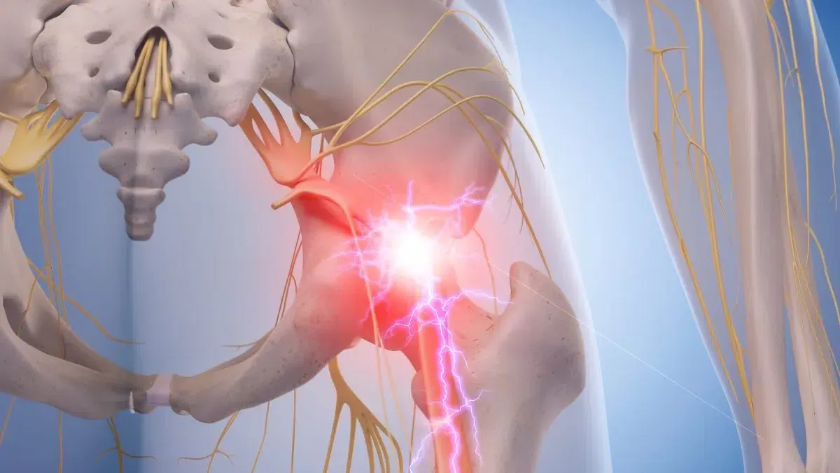 What is Sciatica and What Causes It?