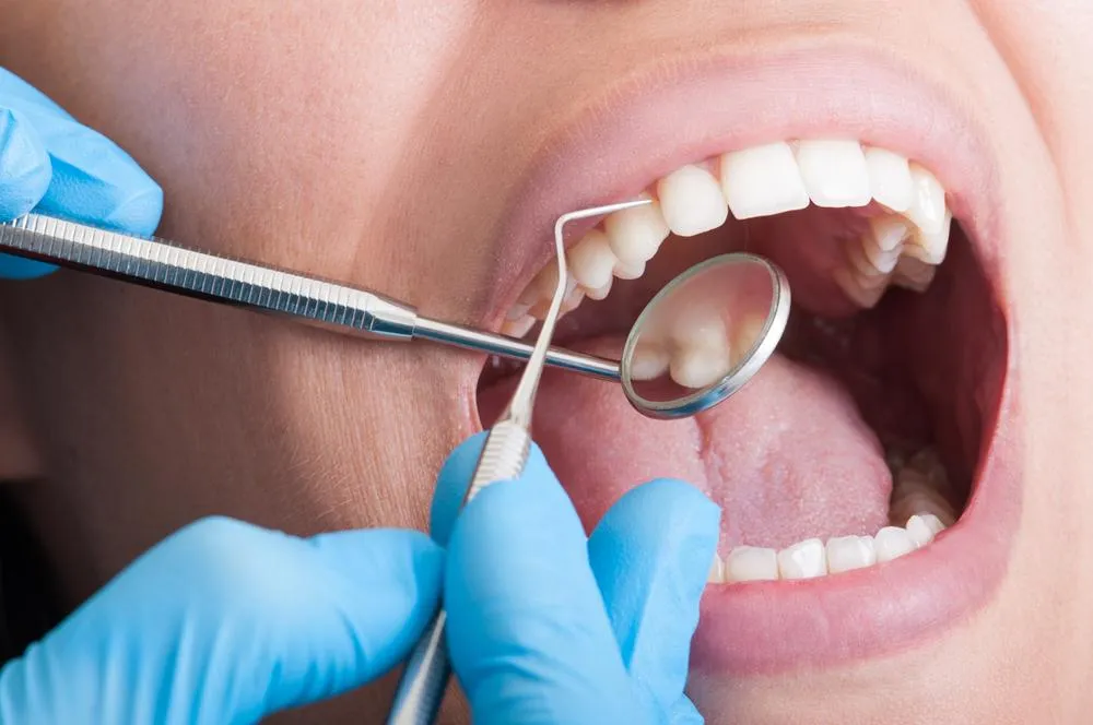 Types of Dental Cleanings in Lakewood CO