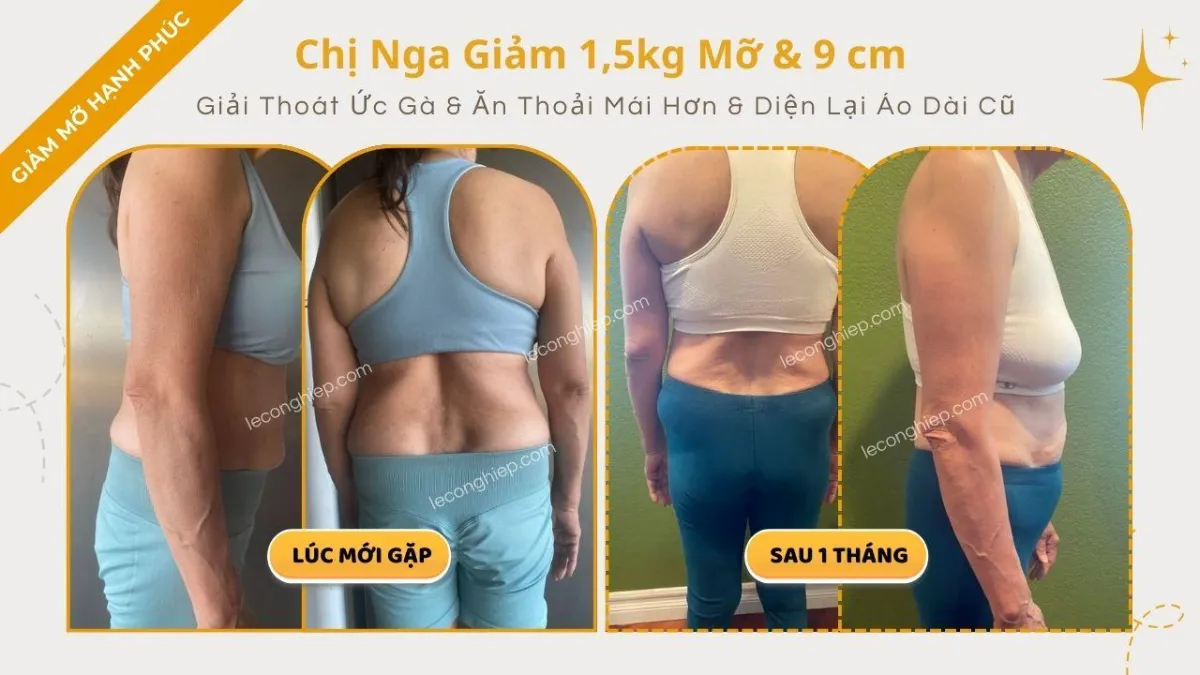 Case Study giảm mỡ toàn diện của chị Nga trong 1 tháng - Giảm Mỡ Hạnh Phúc