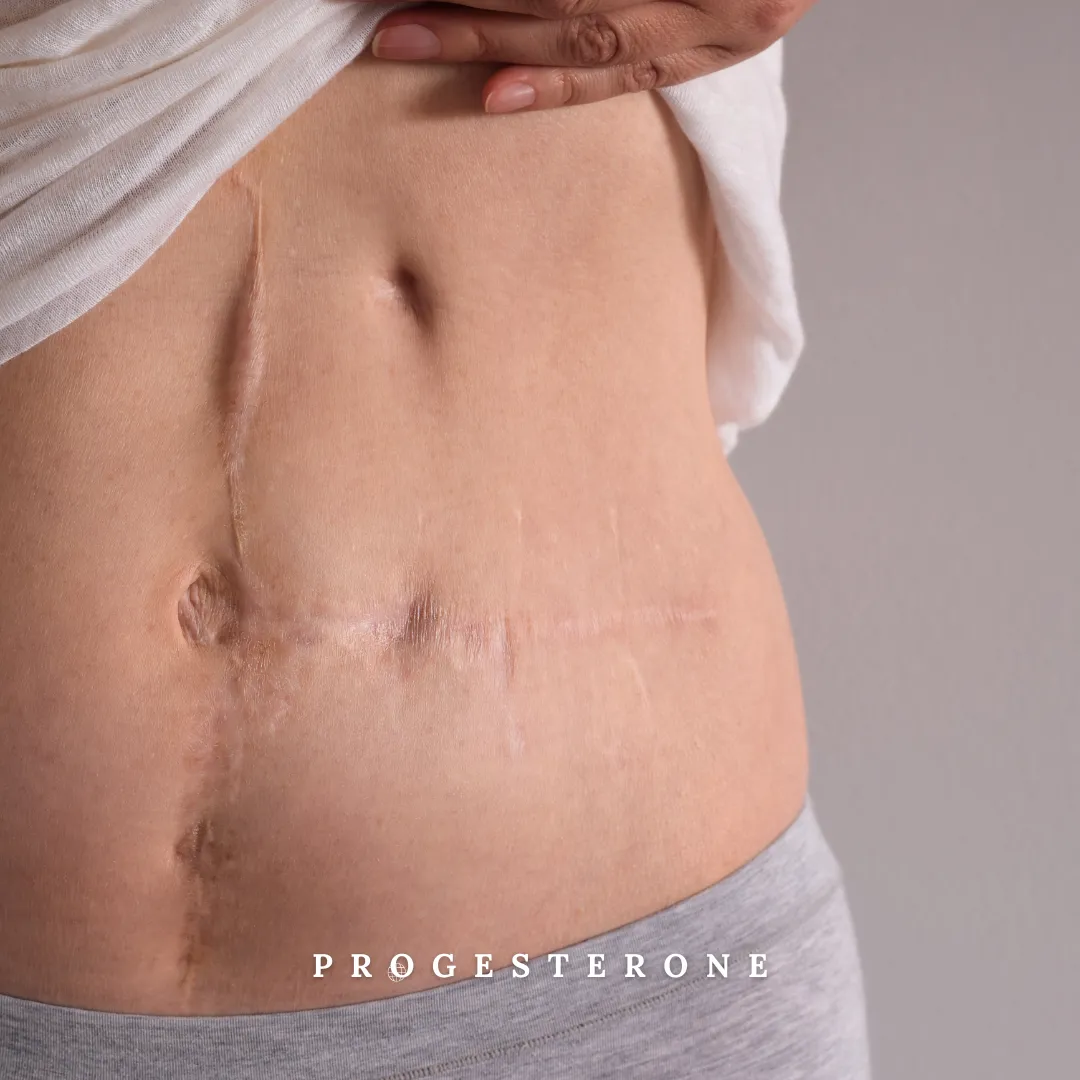 Why You Still Need Progesterone After a Hysterectomy—And What Happens If You Don’t