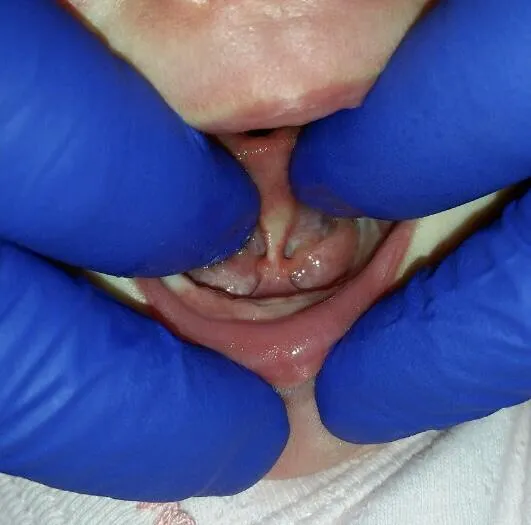 Tongue Tie & Lip Tie: An Introduction & Overview
