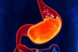 Managing GERD: Boosting Stomach Acid Naturally