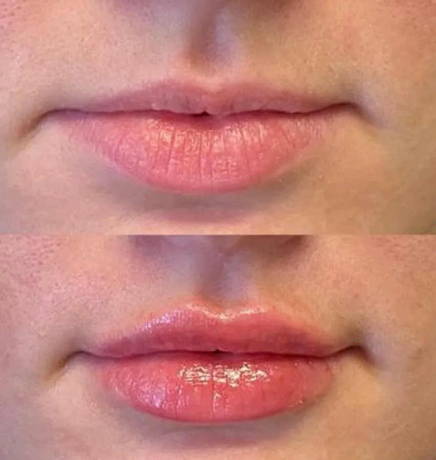 Lip Fillers, Raleigh Nc