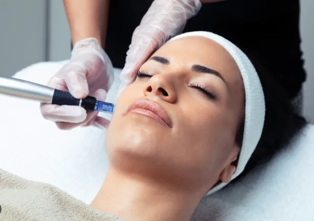 Microneedling treatment