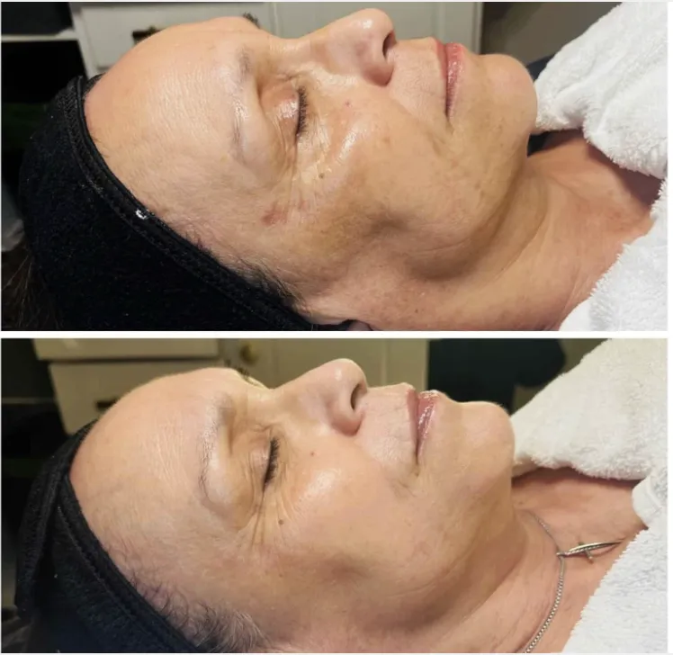 Glo2facial results