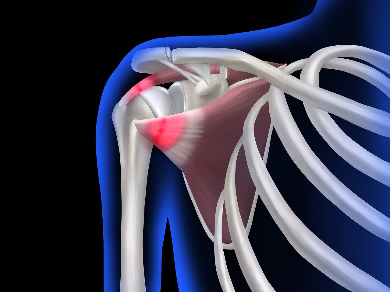 Chiropractic & Acupuncture for Shoulder Pain and Frozen Shoulder in Dunedin, FL