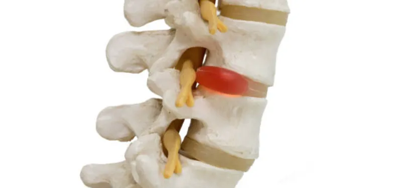 sciatica-bulging-disc