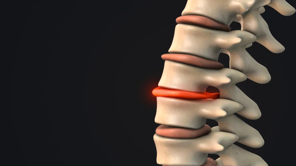 Finding Relief: Understanding Herniated Discs and How AZ Spine Disc and Sport Can Help