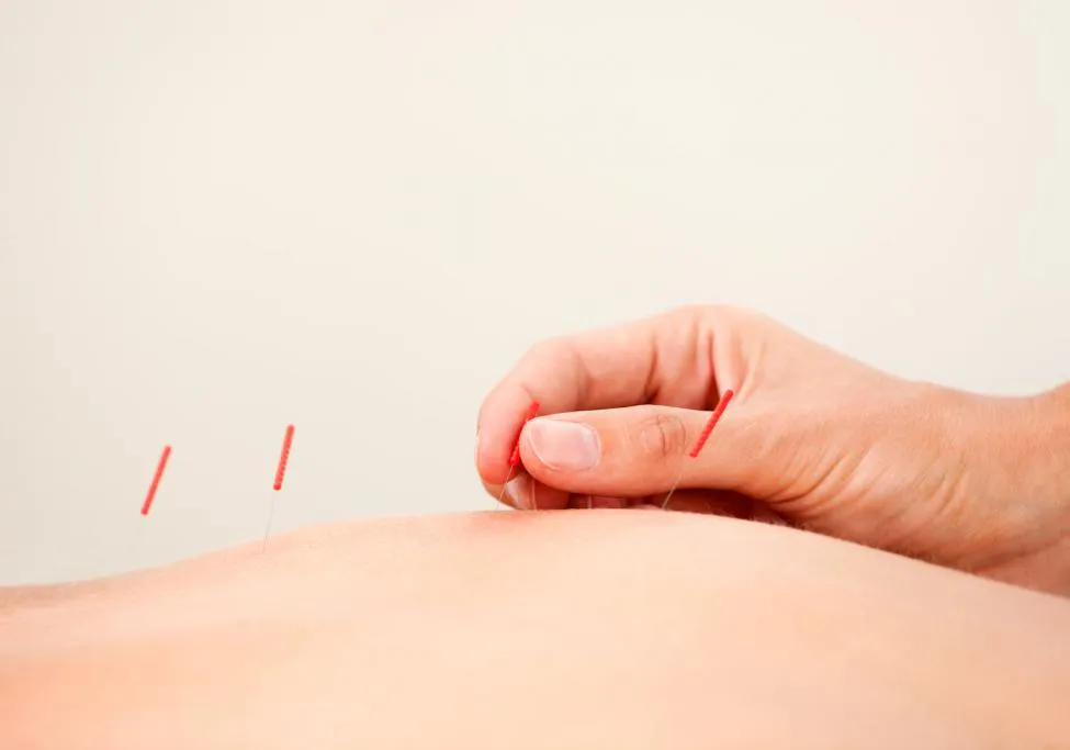 Relieve All Pain In Your Joints And Muscles With Acupuncture