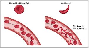 A sickled cell image