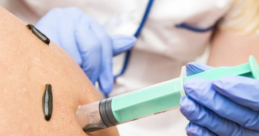 Blutegeltherapie