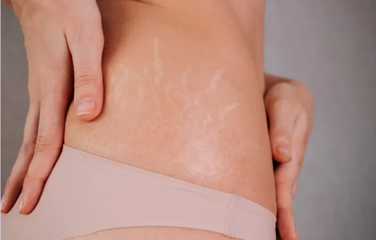 Stretch Marks Reduction