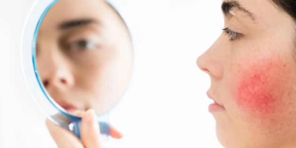 Venus Versa for Rosacea, Broken Capillaries & Redness