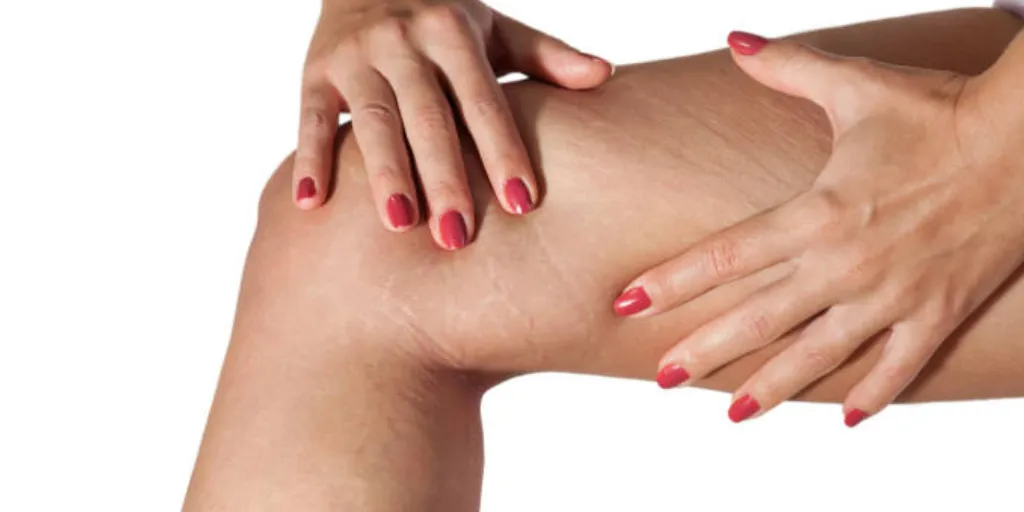 Stretch Marks Reduction with NanoFractional Resurfacing