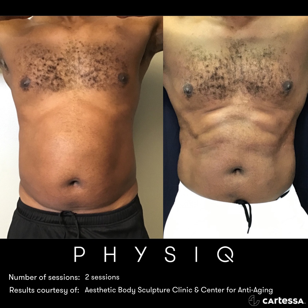 Before and after results of non-invasive body contouring with PHYSIQ showing reduced abdominal fat and increased muscle definition after two sessions.