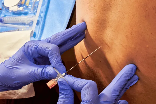 EPIDURAL LYSIS OF ADHESIONS