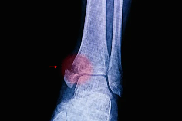 MEDIAL BRANCH BLOCKS