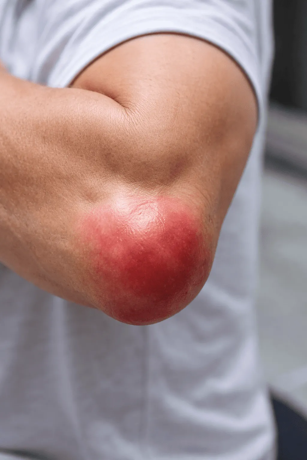 Gomito gonfio e arrossato con evidente infiammazione della borsa sierosa, tipico aspetto clinico di borsite olecranica.