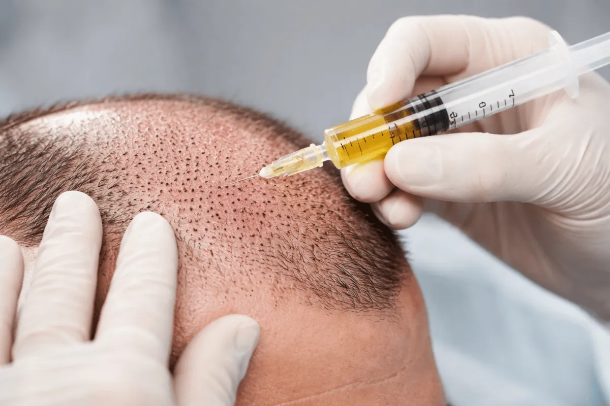 SEDUTE DI PRP O PRF DOPO FUE O DHI: COSA CONSIGLIANO I TRICOLOGI