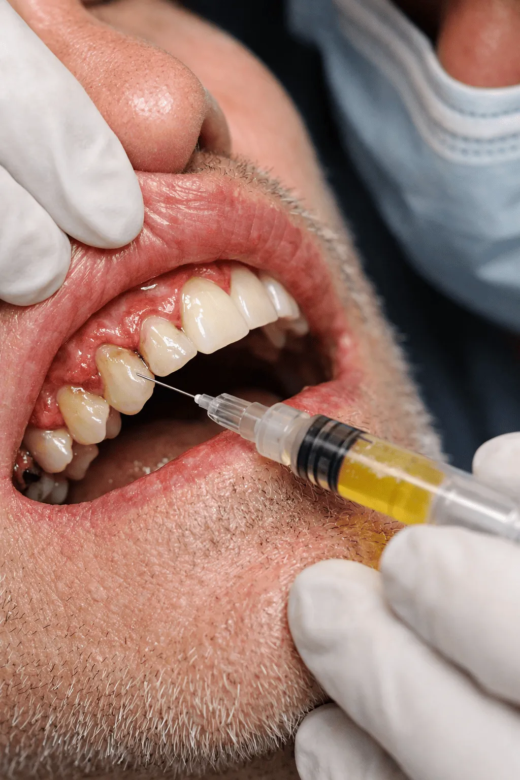 Infiltrazione di i-PRF nelle gengive colpite da parodontosi, con focus su denti e tessuti gengivali infiammati durante un trattamento di medicina rigenerativa odontoiatrica.