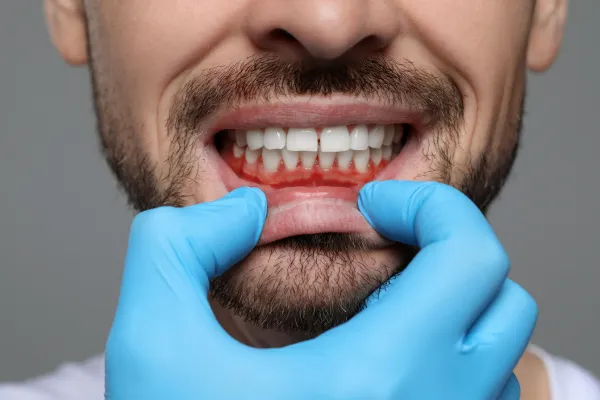 Find out what to do with gum recession in Grand Junction, CO