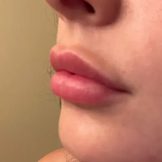 Lip Filler Migration