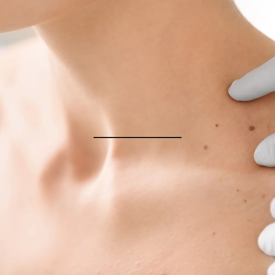 Check Yourself: DIY Skin Tumor Detection