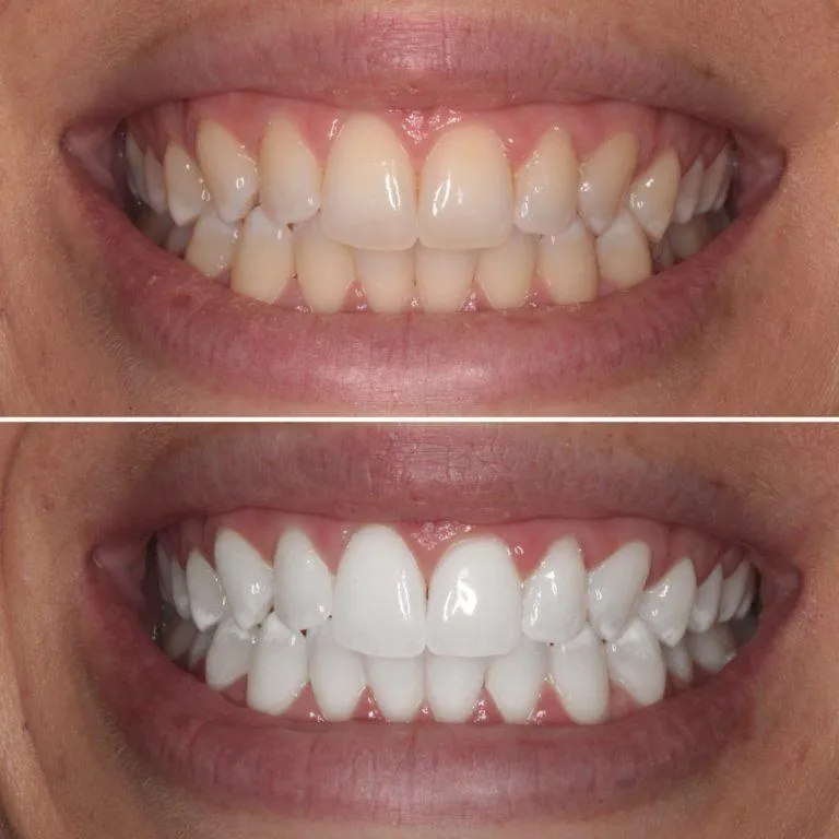 Withen Your Teeth Without Toxic Chemicals...