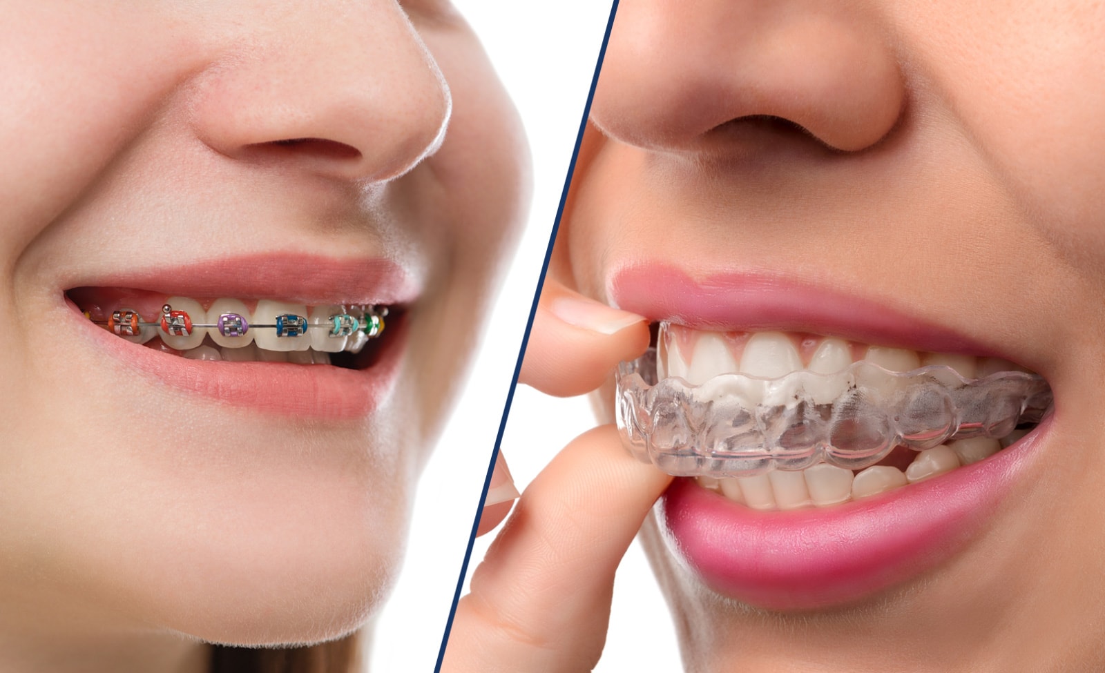 Teeth Straightening Options in Wimbledon: Braces vs Invisalign