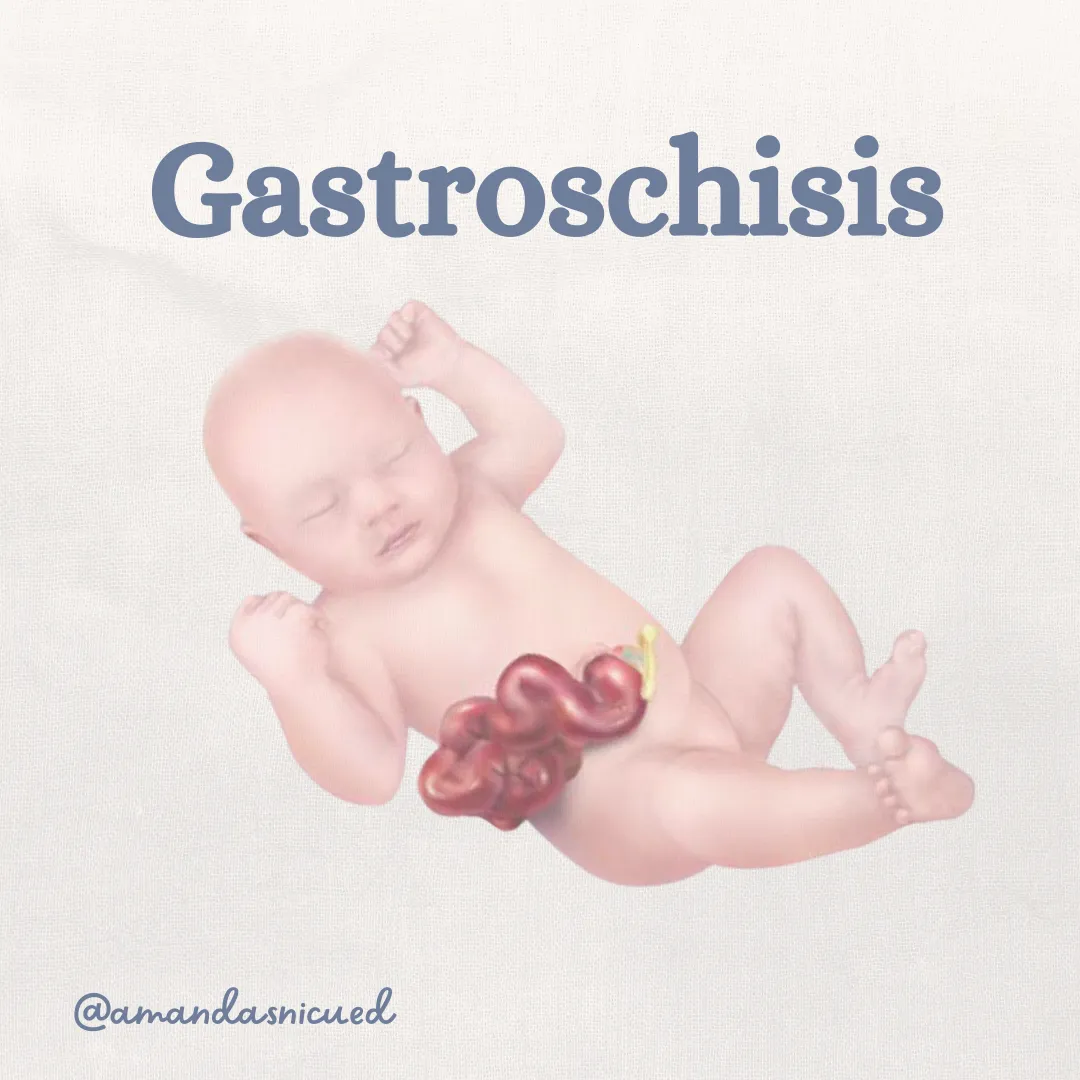 gastroschisis, white background