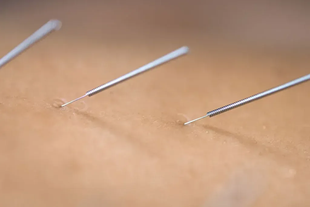 Benefits of Dry Needling