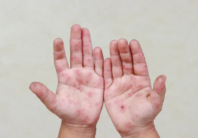 Éruption cutanée sur les mains d’un enfant atteint de rougeole, illustrant les signes typiques de la maladie.
