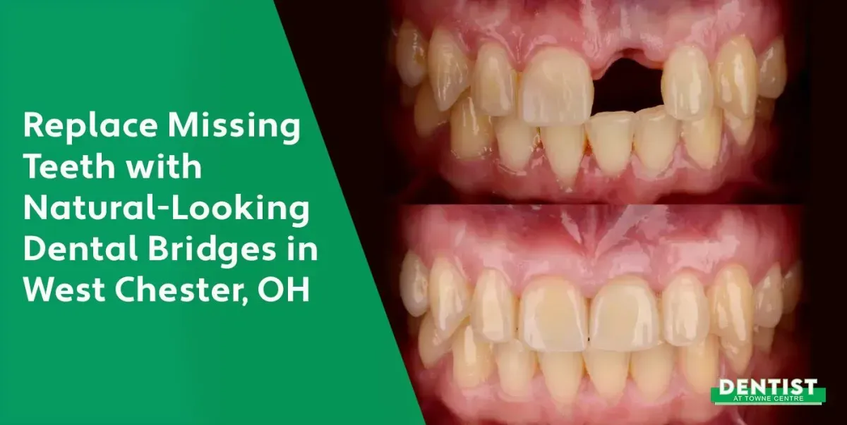 Restoring Smiles with Dental Bridges in West Chester, OH