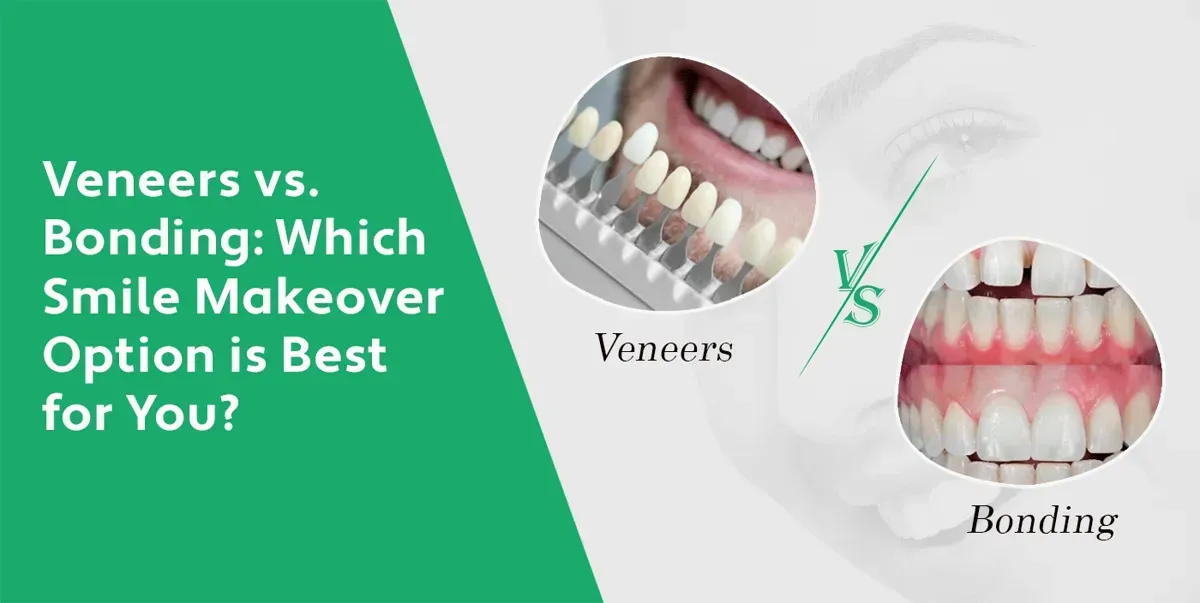 Veneers vs. Bonding | Compare Your Smile Makeover Options