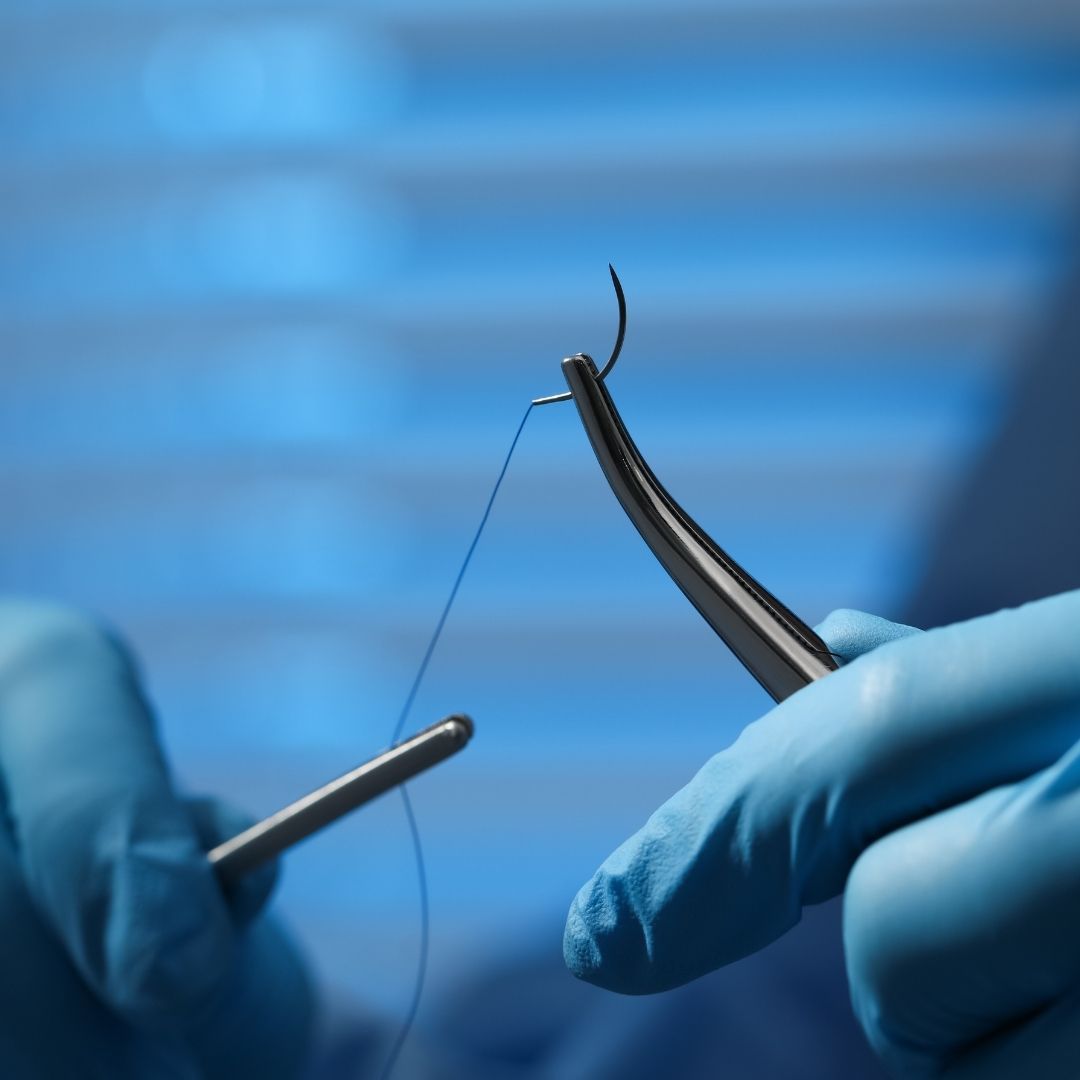 When Should Sutures Be Removed? Types, Timing, and Care