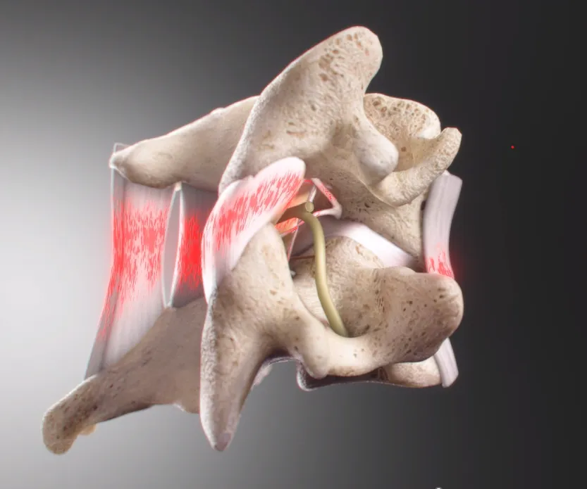 Why Cervical Sprains Can Mean More Than Disc Injuries