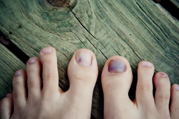 discolored nails