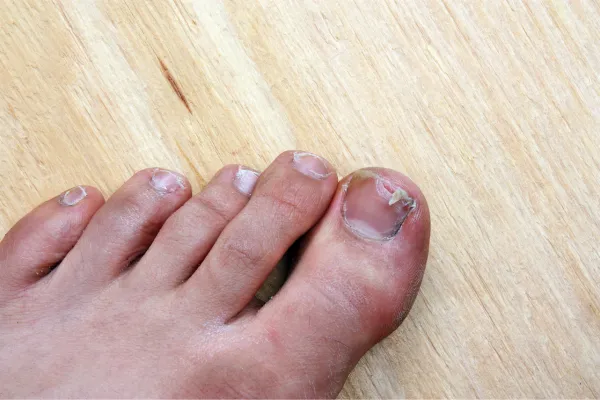 broken toenail