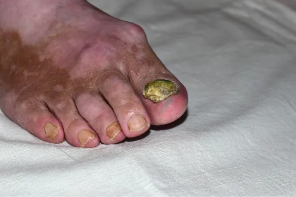 fungal toe nail infection