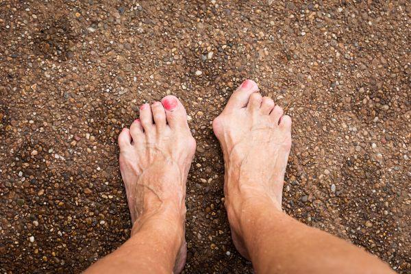 woman hammertoes